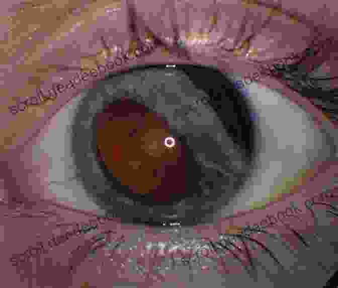 High Resolution Photograph Of A Traumatic Iris Injury, Demonstrating The Extent Of Damage And The Need For Surgical Repair. Mastering Iris Repair: A Video Textbook Of Iris Repair And Pupilloplasty Techniques