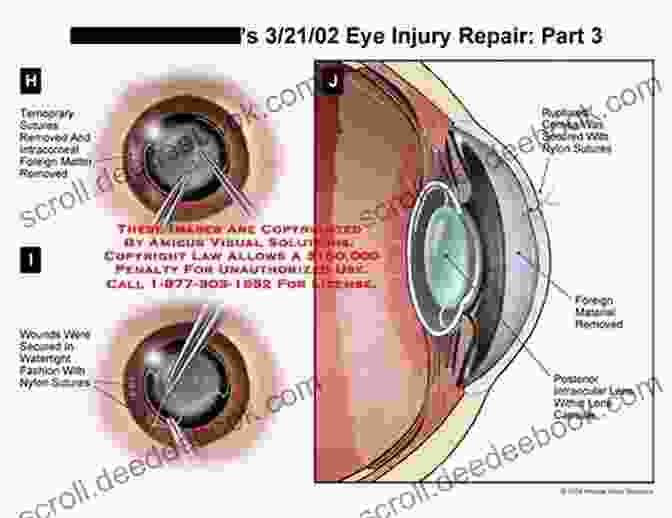 Still Image From A Video Demonstrating The Delicate Process Of Primary Iris Repair, Illustrating The Precise Placement Of Sutures And Meticulous Handling Of Tissues. Mastering Iris Repair: A Video Textbook Of Iris Repair And Pupilloplasty Techniques