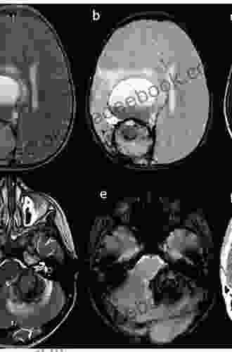 Central Nervous System Metastases Laurent Tailhade