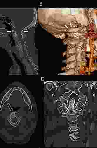 Surgery of the Cranio Vertebral Junction